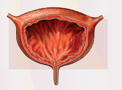 Cystitis jelei