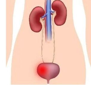 A nők cystitis kialakulásának okai