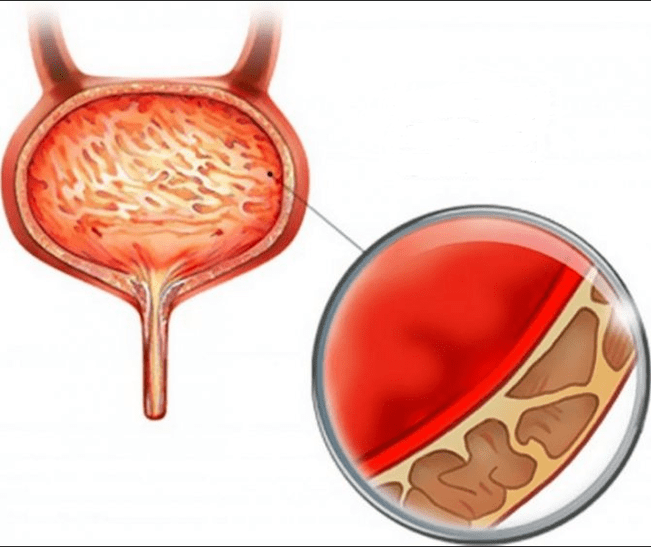 Cystitis gyulladás