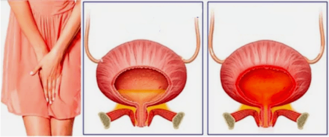 Krónikus cystitis