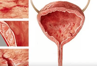 A nők cystitis kialakulásának okai