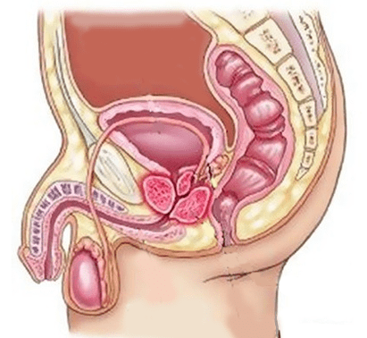 A cystitis okai férfiaknál